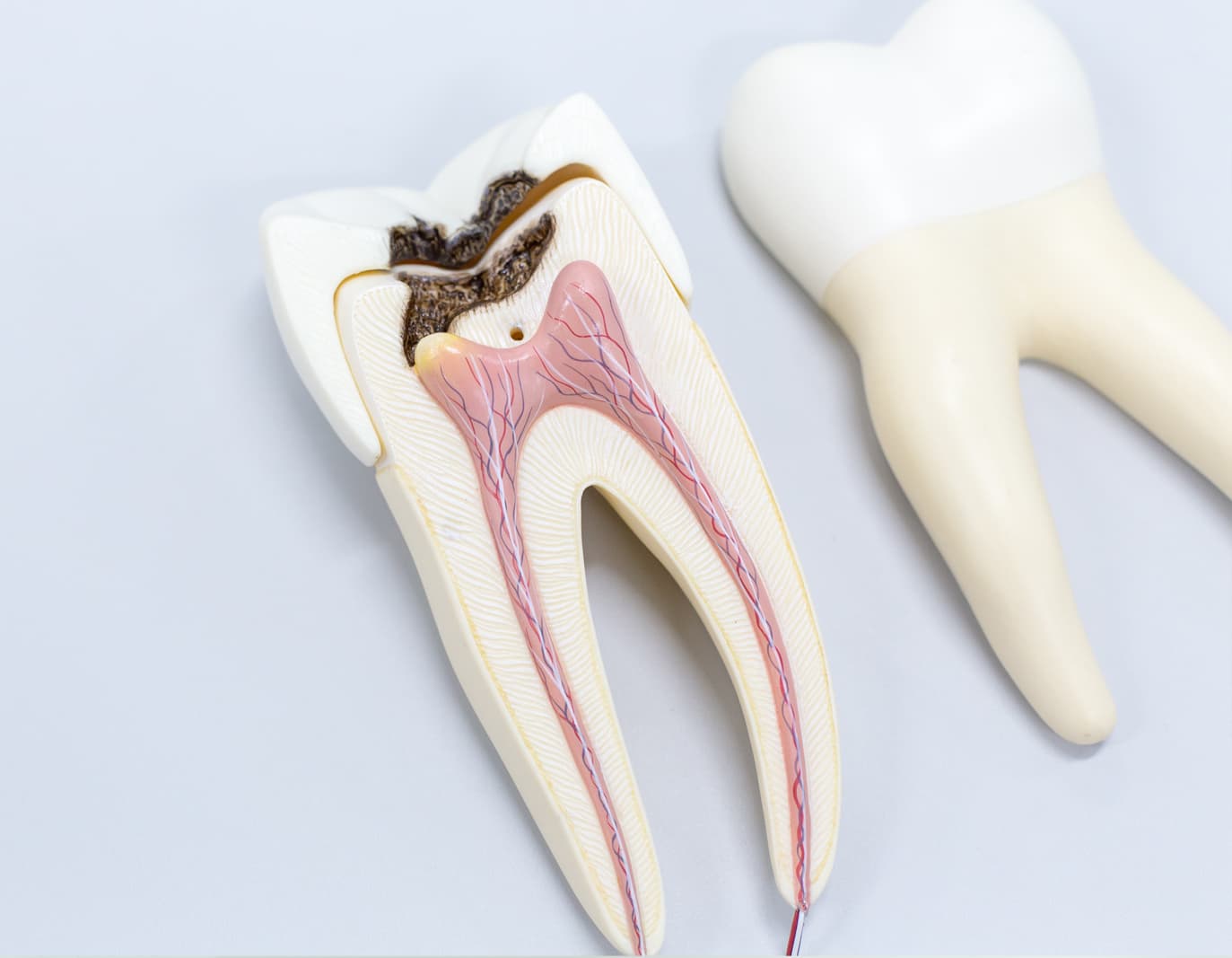 Tratamiento de endodoncia en Vigo