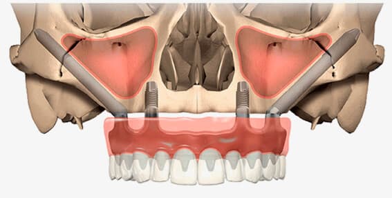 implante dental cigomático